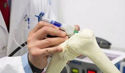墨尔本亚裔医生用3D打印笔“绘”出膝盖软骨